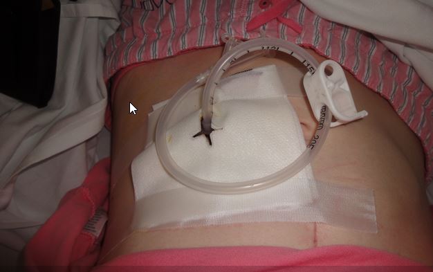 feeding_tube_image.jpg